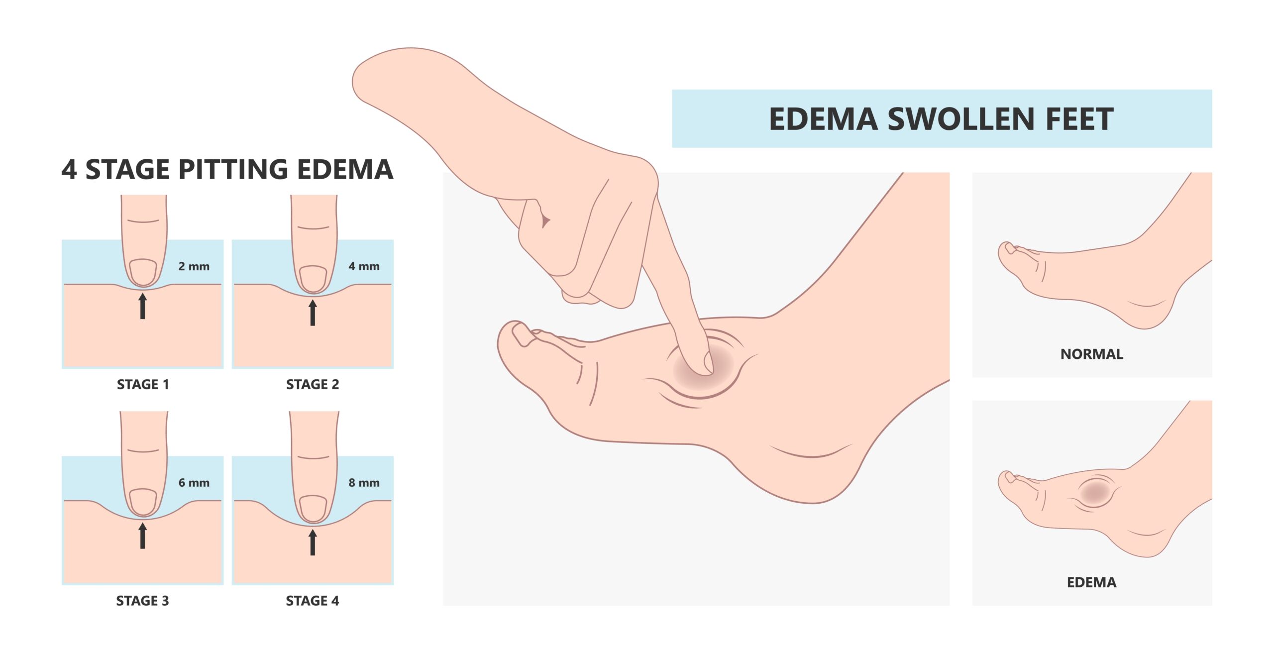 Edema: What Is, Causes, Symptoms, and Treatment