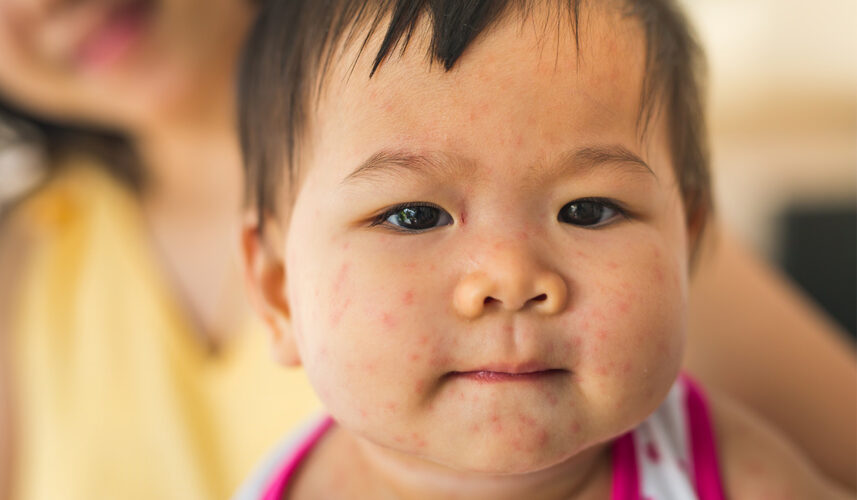 Mononucleosis: What Is, Symptoms, Diagnosis, and Treatment