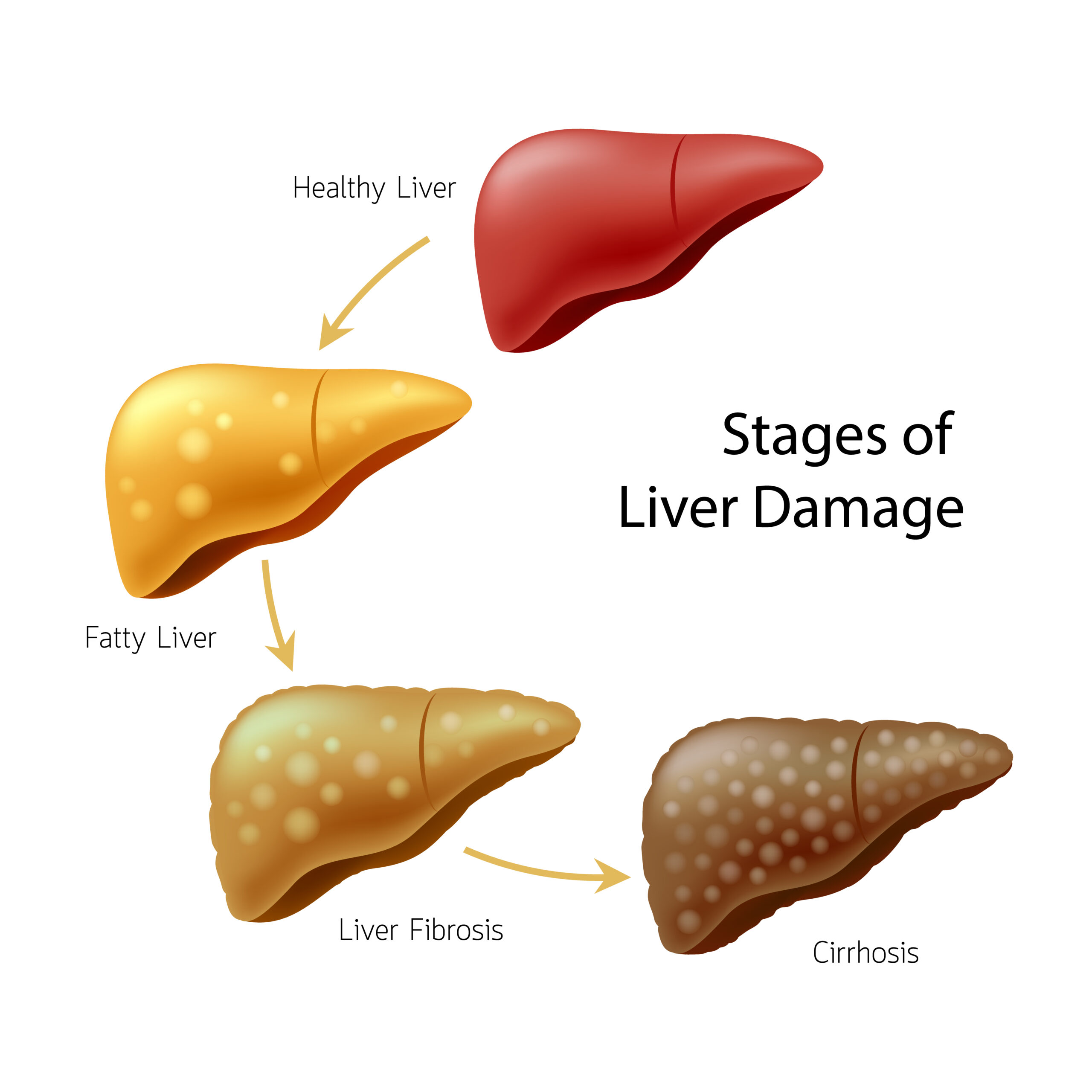 Cirrhosis of The Liver: Symptoms, Causes, and Diagnosis