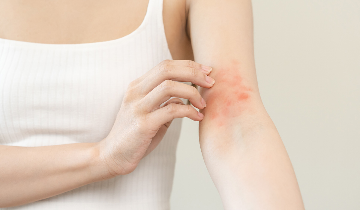 Eczema: What It Is, Symptoms, Types, and Treatment