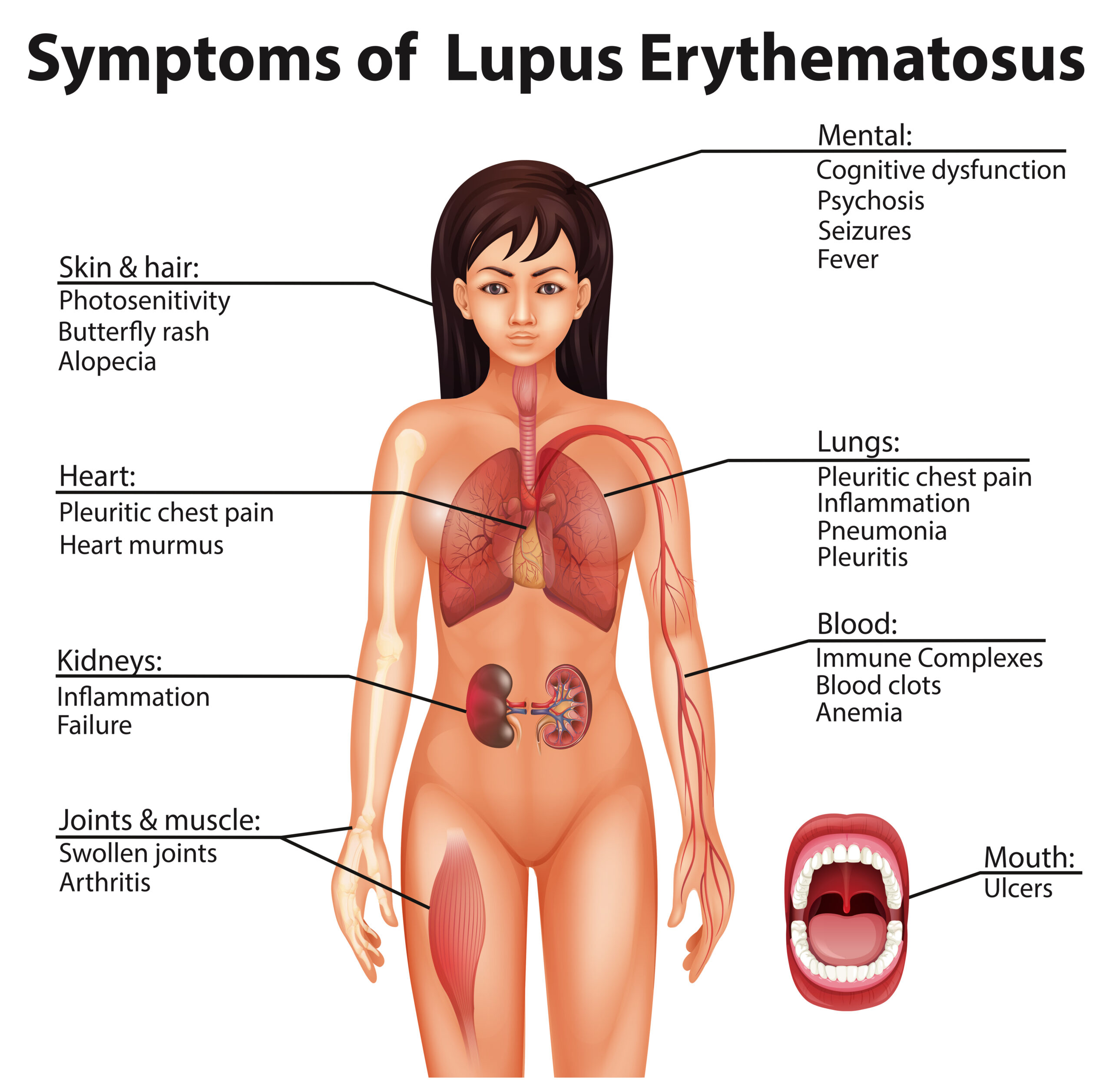 Lupus: Symptoms, Causes, Types, and Treatments