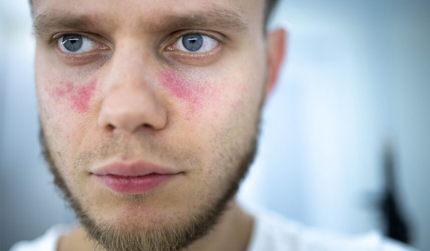Lupus: Symptoms, Causes, Types, and Treatments