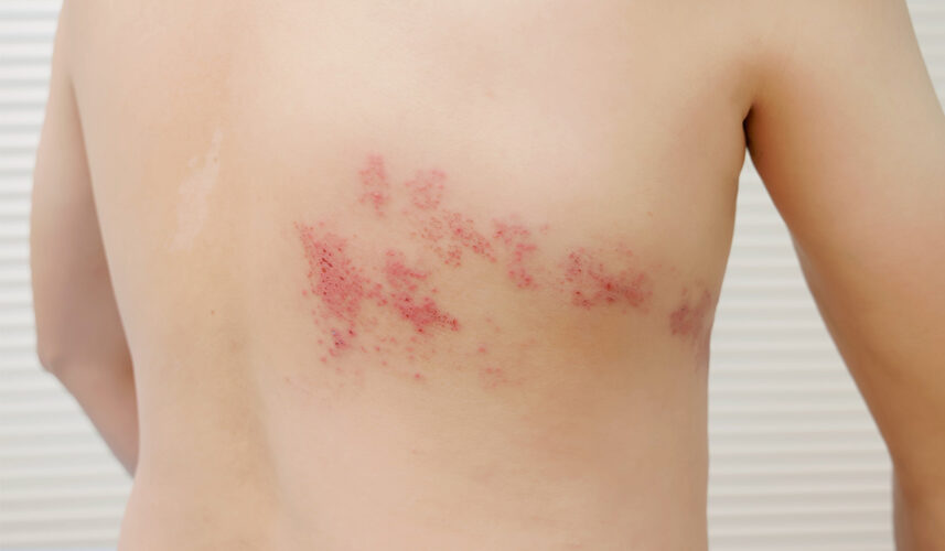 Shingles: What Is, Diagnosis, Symptoms, and Treatment