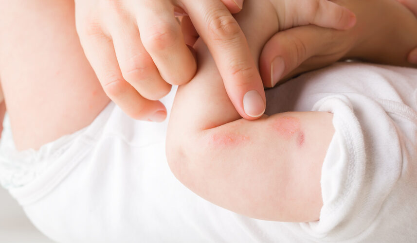 Hives: Causes, Types, and Effective Treatment