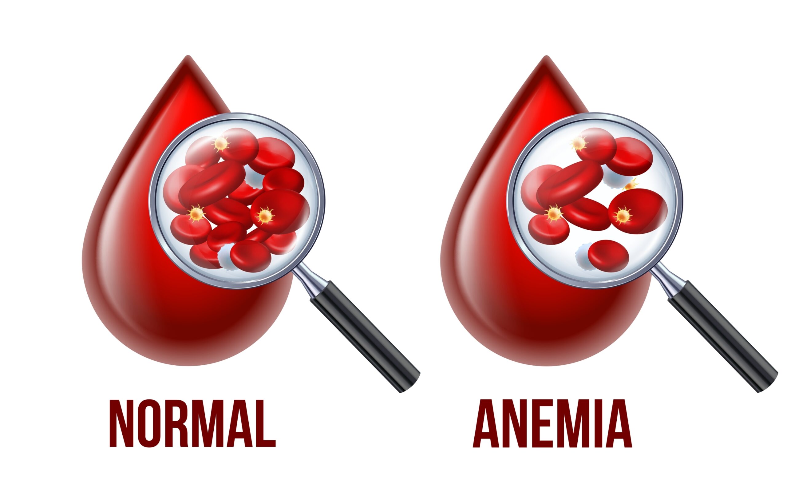 Anemia: Causes, Symptoms, Types, Diagnosis and Treatment