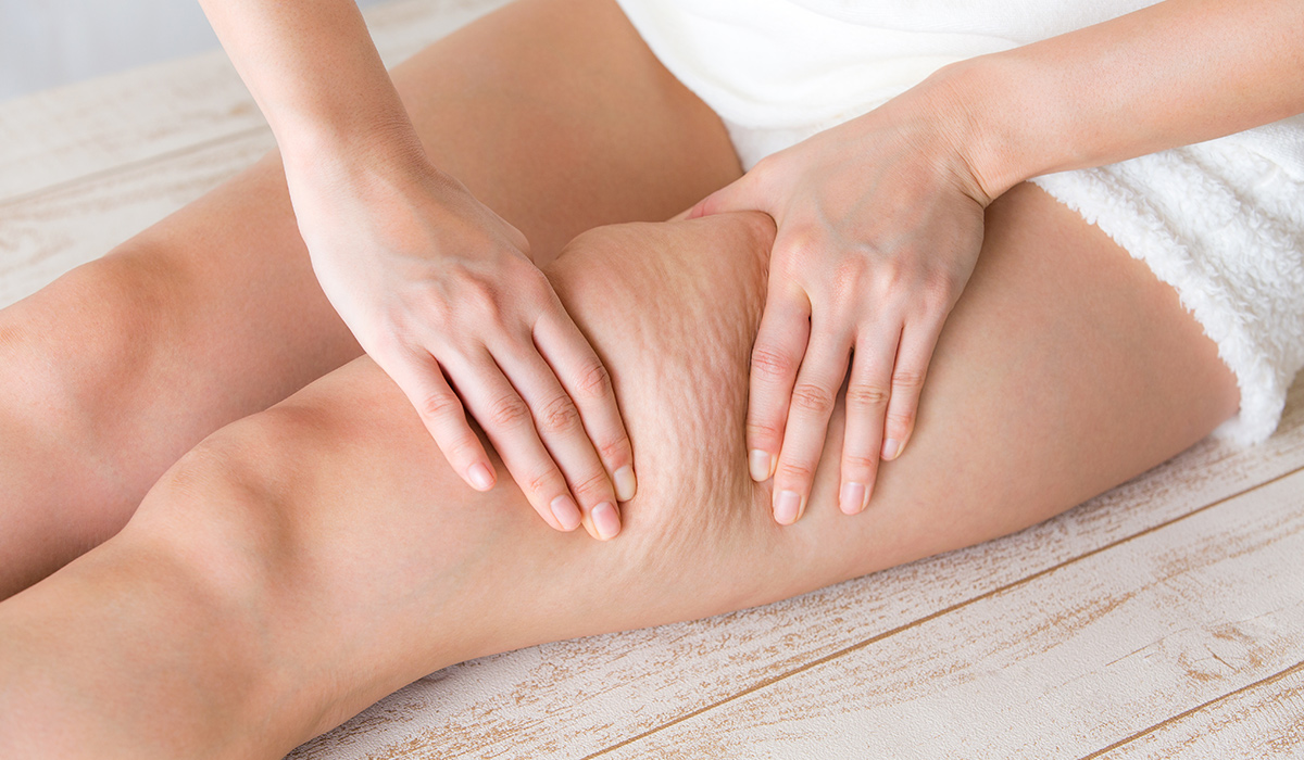 Cellulite: Causes, Effective Treatment, and Prevention