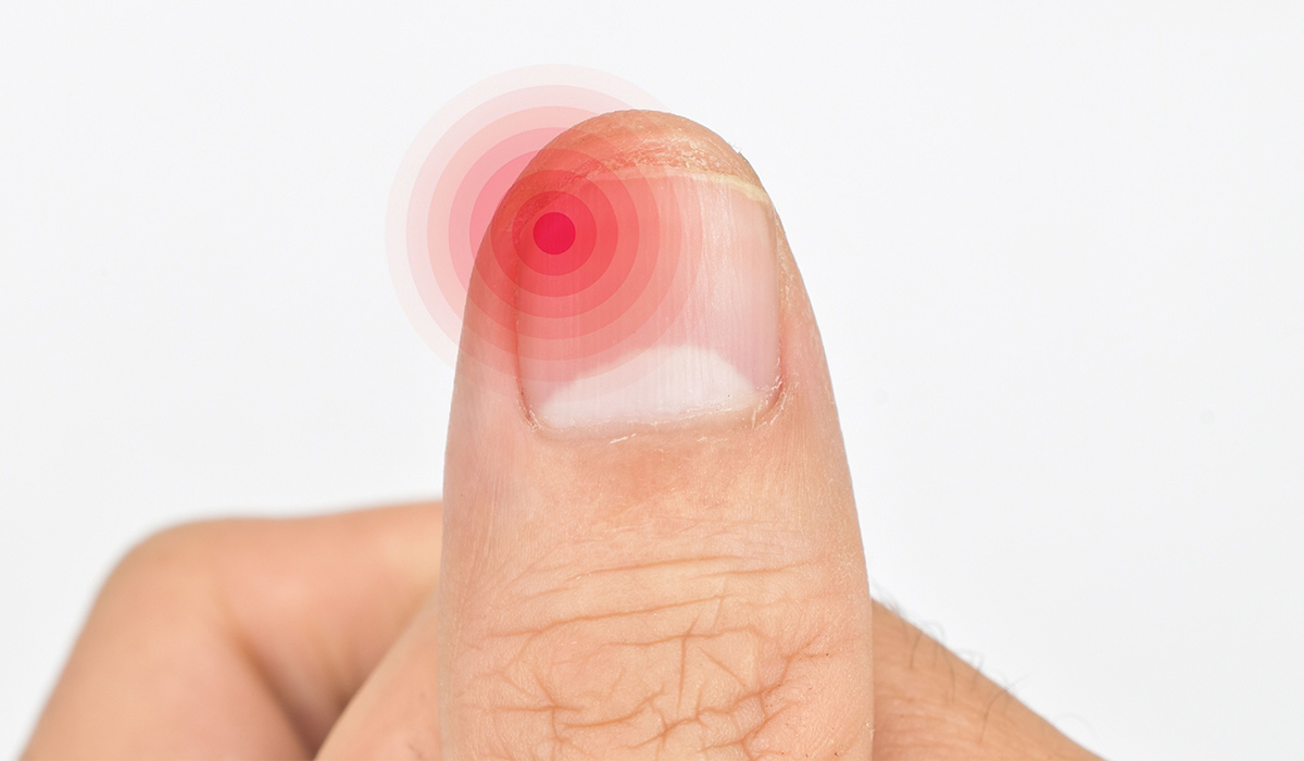 Paronychia (Nail Infection): What Is It, Symptoms, Causes, and More