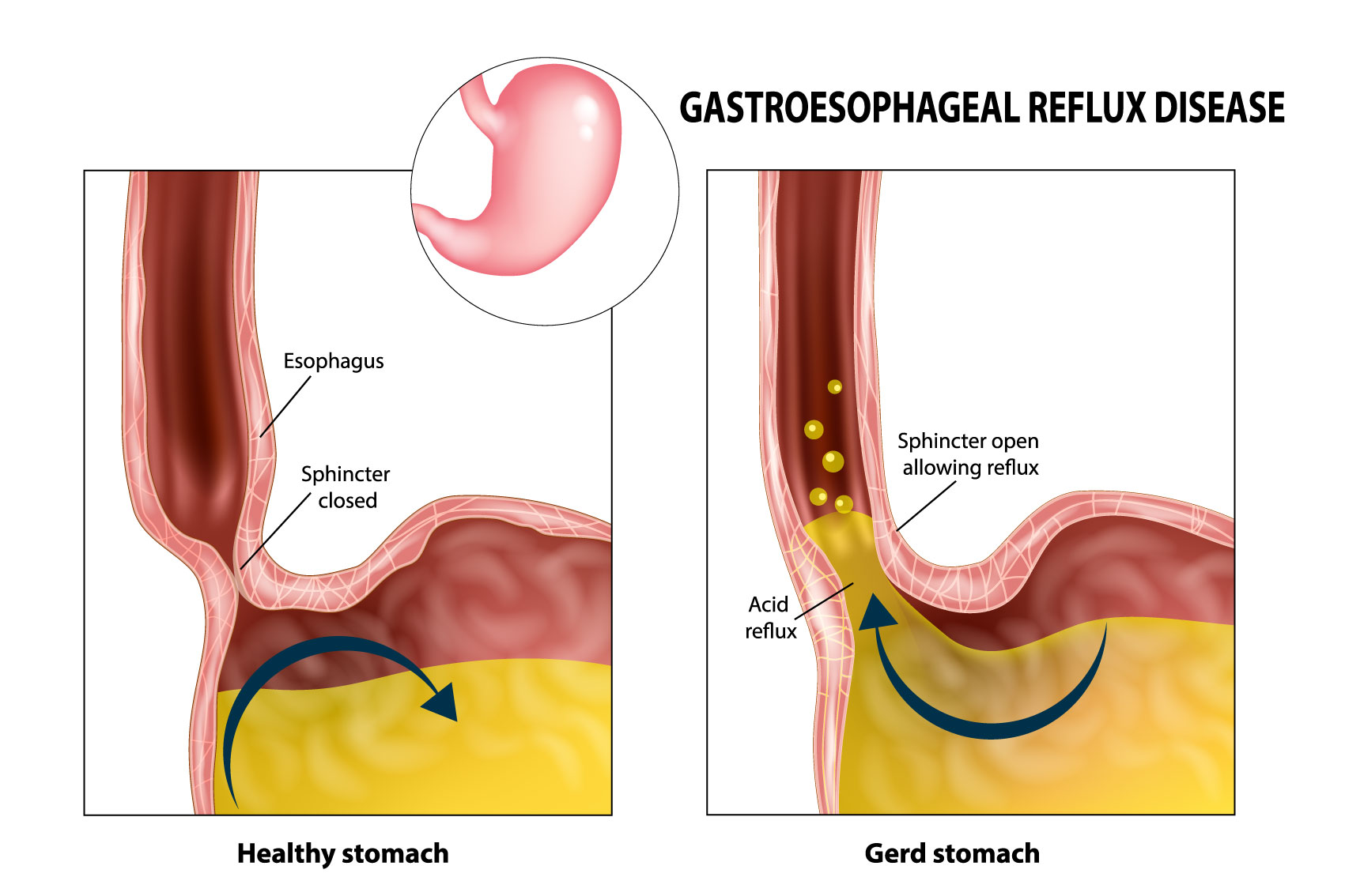 GERD: What Is, Symptoms, Causes, and Treatments
