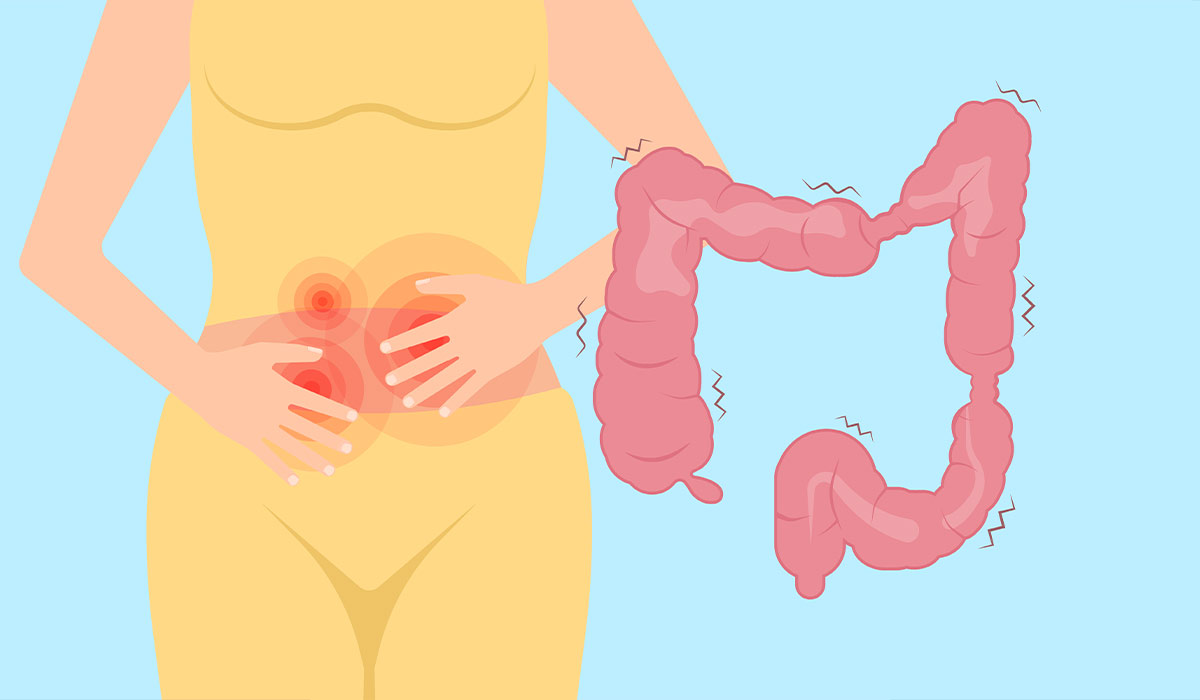 IBS - Irritable Bowel Syndrome: What It Is, Symptoms, Causes, and Treatment