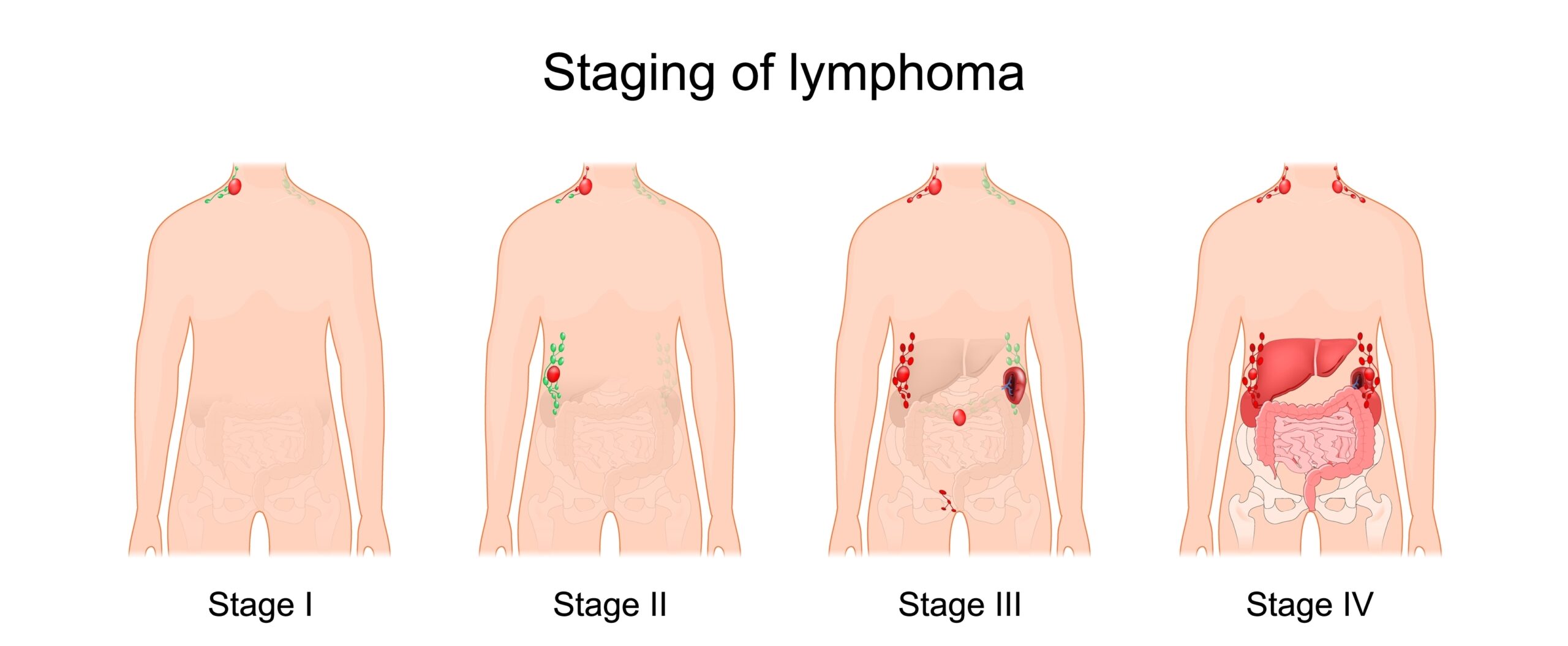 Lymphoma: Symptoms, Causes, and Treatment