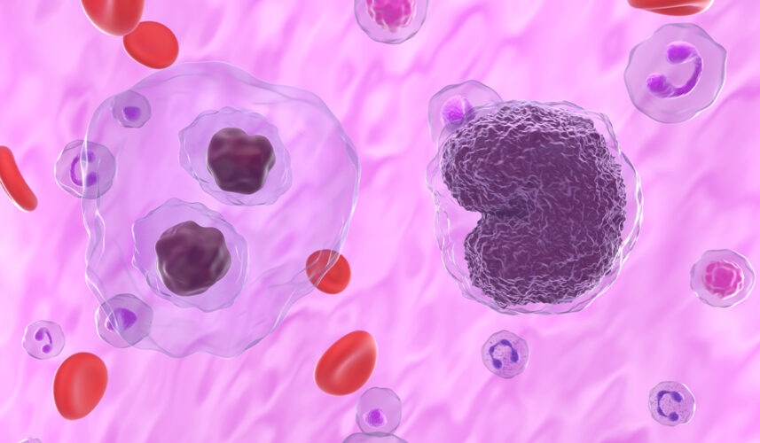 Lymphoma: Symptoms, Causes, and Treatment