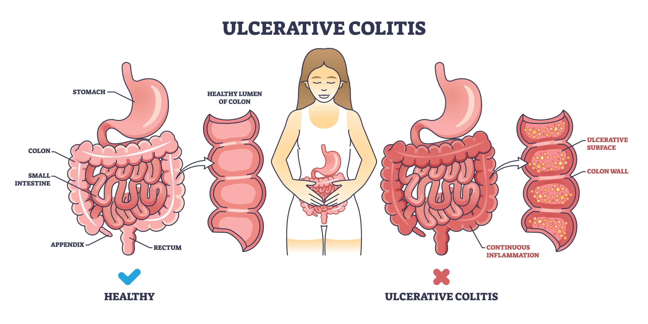 Ulcerative Colitis: Symptoms, Causes, and Diet