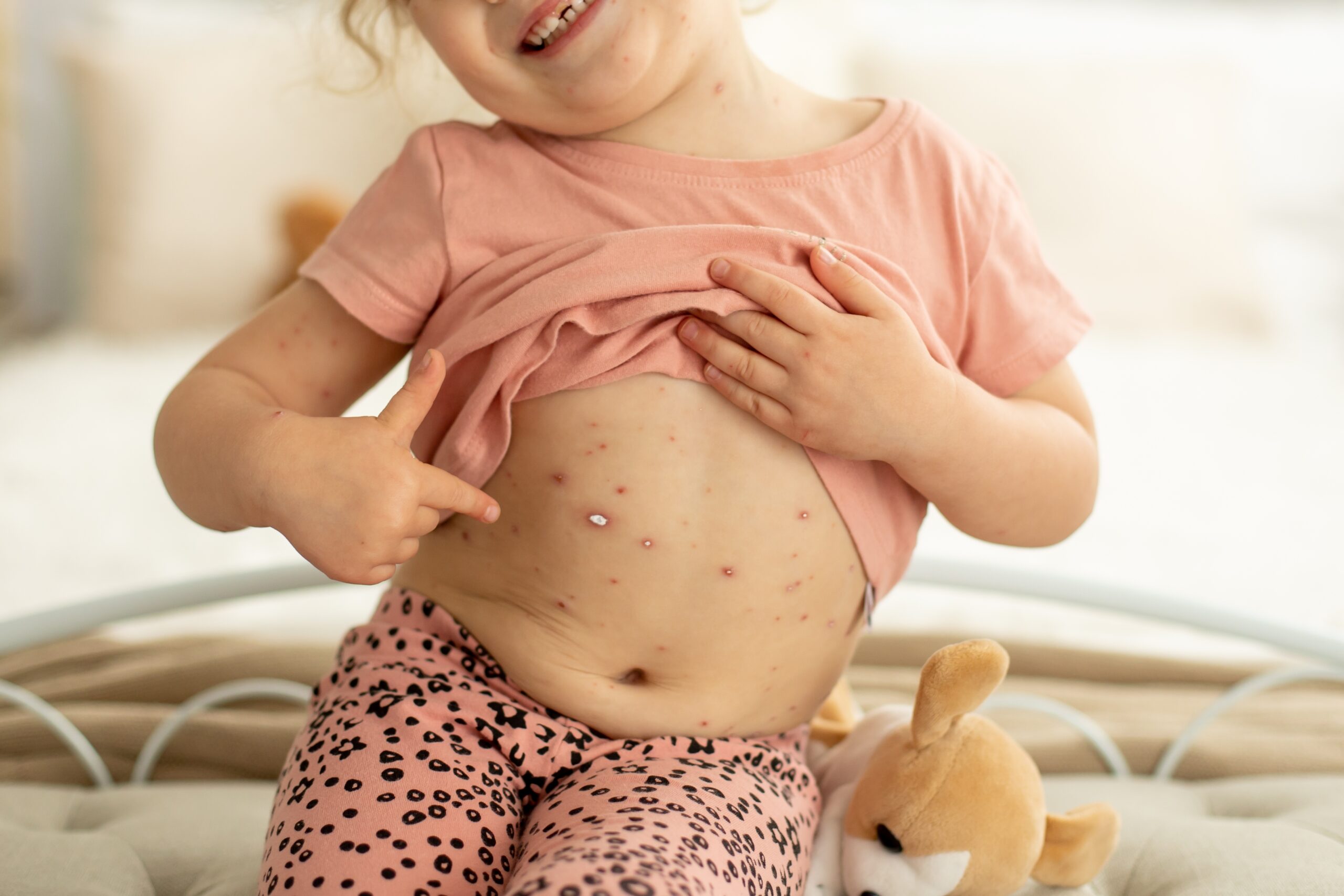 Chickenpox: Causes, Symptoms, and Treatment