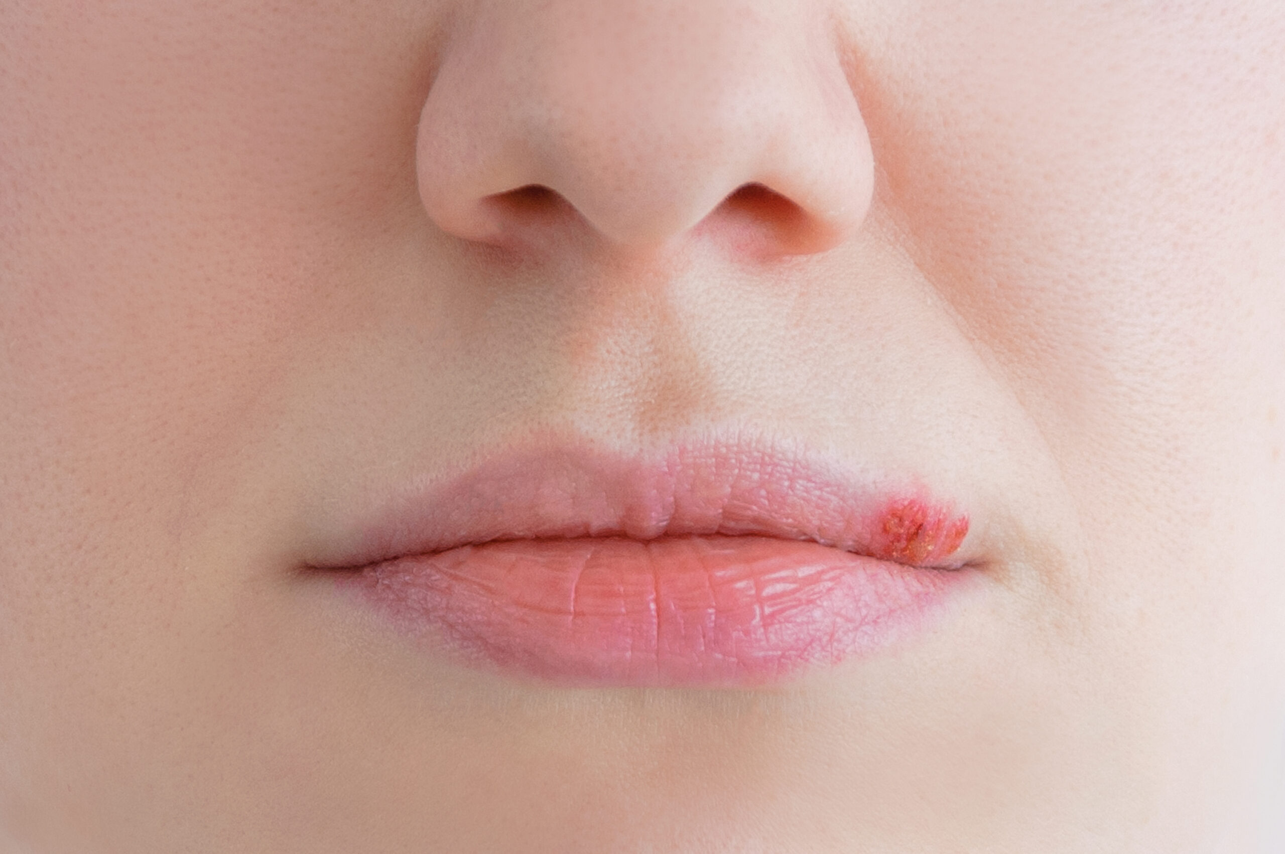 Herpes: What Is, Types, Symptoms, and Treatment