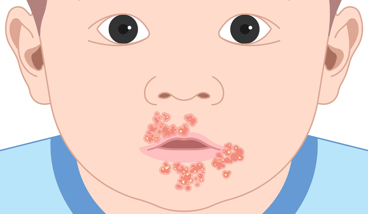 Impetigo: What Is, Causes, Treatment, Risk Factors, and Self-Care Advice