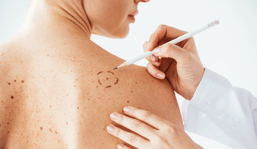 Melanoma: What Is, Types of Melanoma, Diagnosis, and Treatment