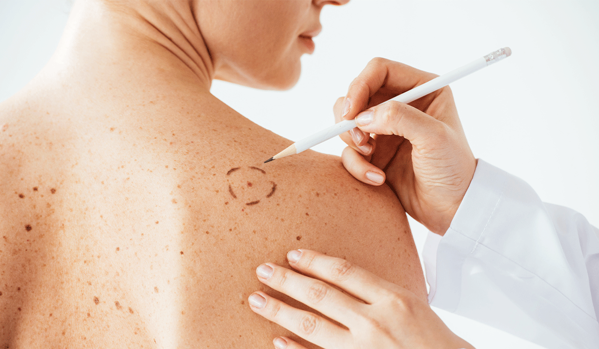 Melanoma: What Is, Types of Melanoma, Risk Factors, Diagnosis, and Treatment