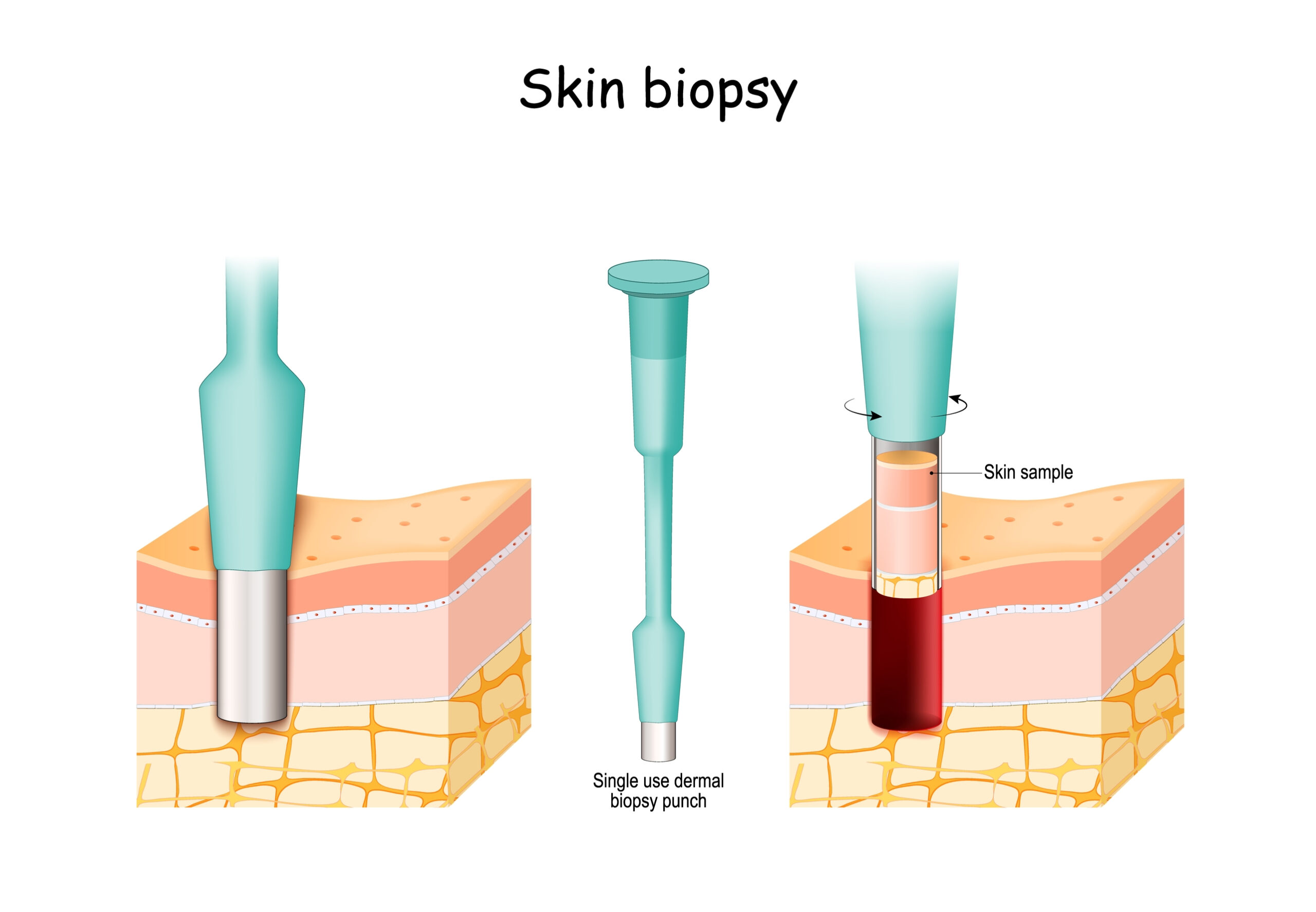 Biopsy