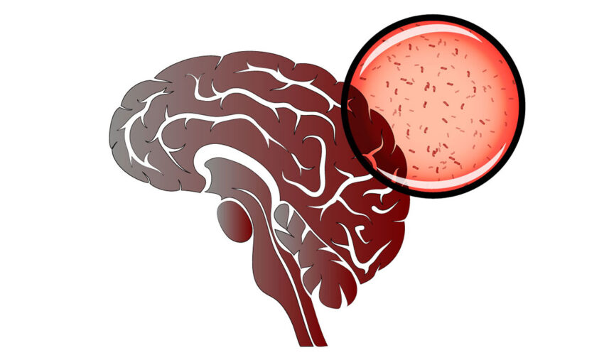 Meningitis: What Is, Types, Alarming Symptoms, and Treatment