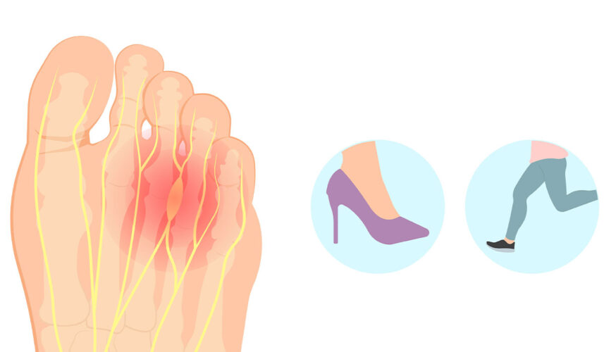Morton's Neuroma: What Is, Causes, Symptoms, Diagnosis, and Treatment