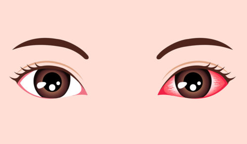 Pink Eye (Conjunctivitis)