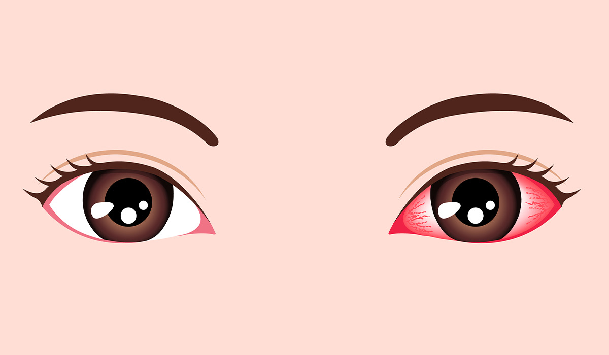 Pink Eye