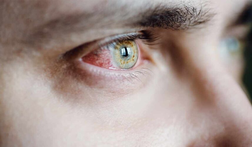 Pink Eye - Conjunctivitis: What Is, Types, Symptoms, How to Treat, and ...