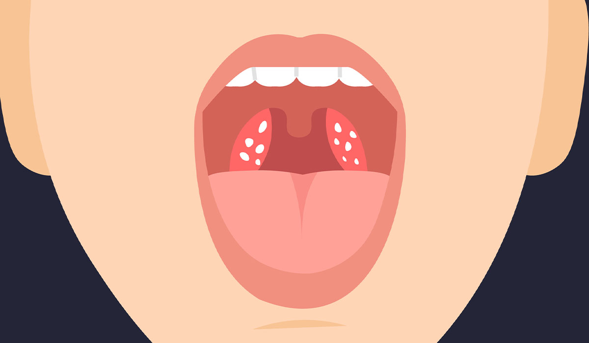 Tonsil Stones: What Is, Risk Factors, Symptoms, and Treatment