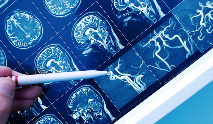 Vascular Dementia: What Is, Causes, Types, Diagnosis, and Stages