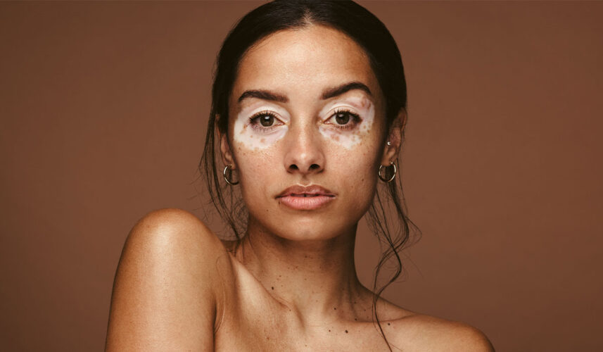 Vitiligo: What Is, Symptoms, Causes and Treatment