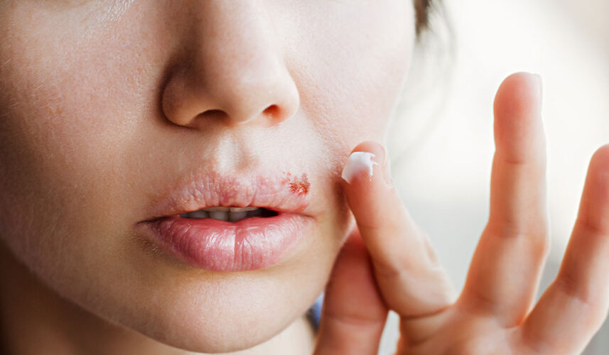 Cold Sores: What Is, Causes, Symptoms, Stages, and Treatment
