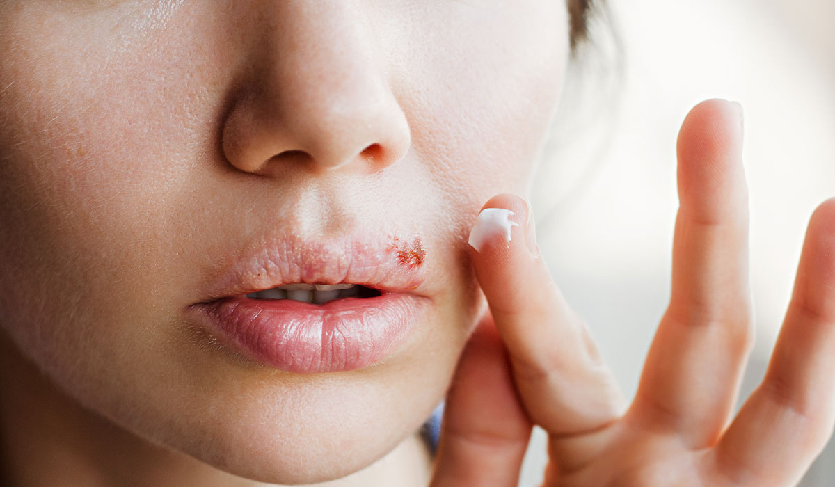 Cold Sores: What Is, Causes, Symptoms, Stages, And Treatment
