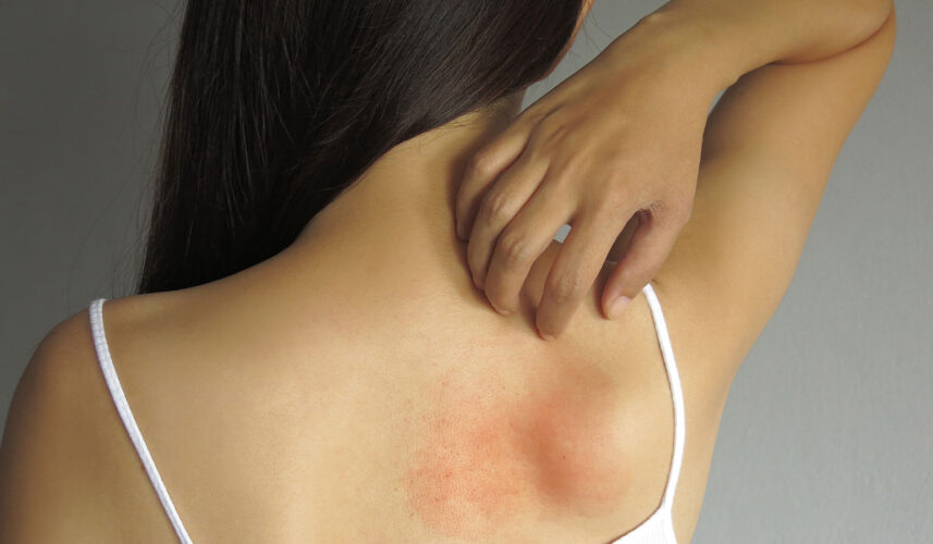 Heat Rash: What Is, Symptoms, Types, and Causes
