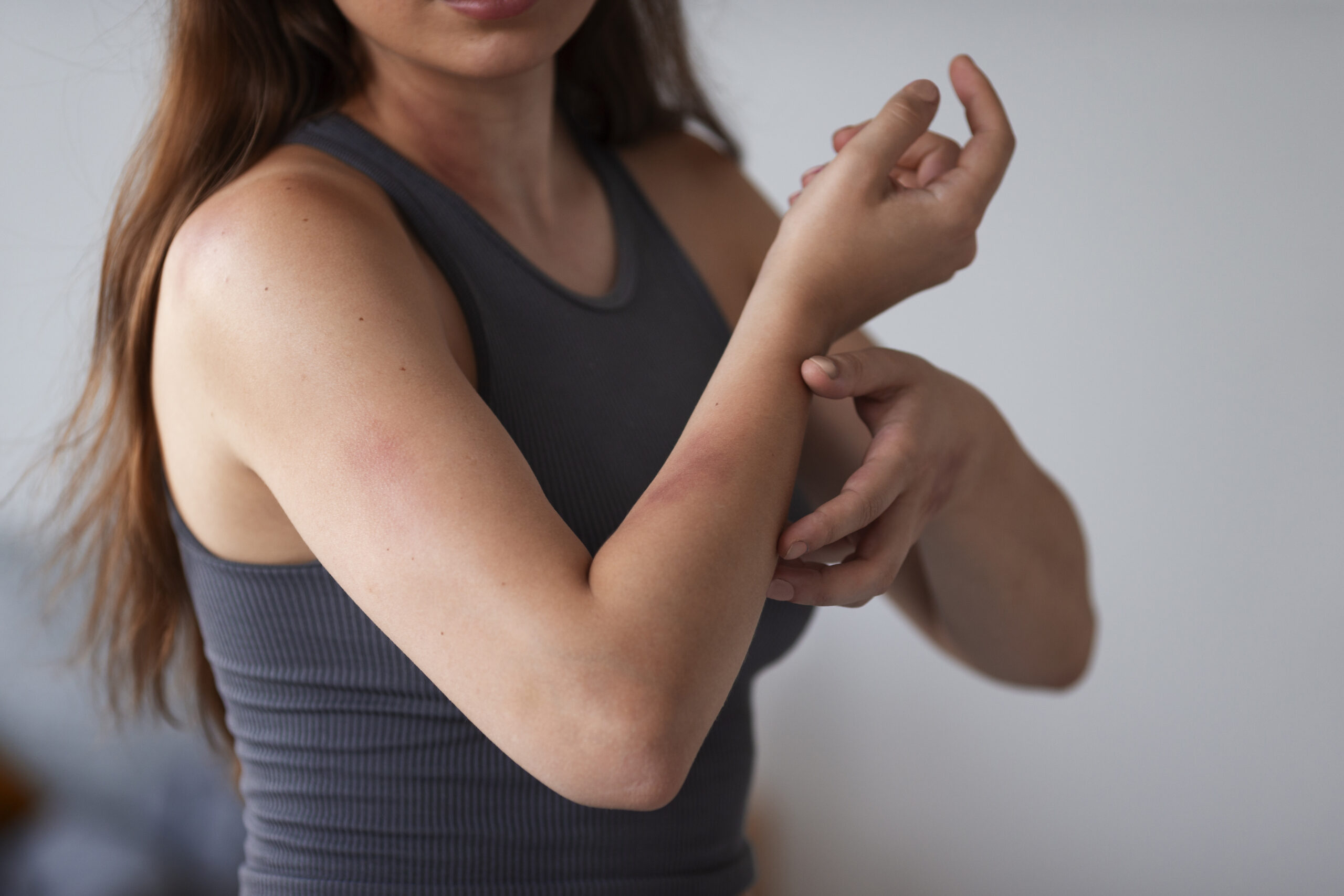 Heat Rash: What Is, Symptoms, Types, and Causes