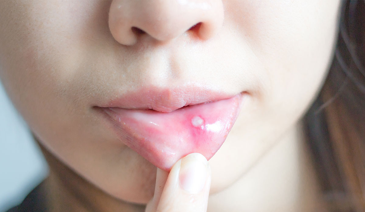 Oral Thrush: What Is, Causes, Risk Factors, Treatment, And Prevention
