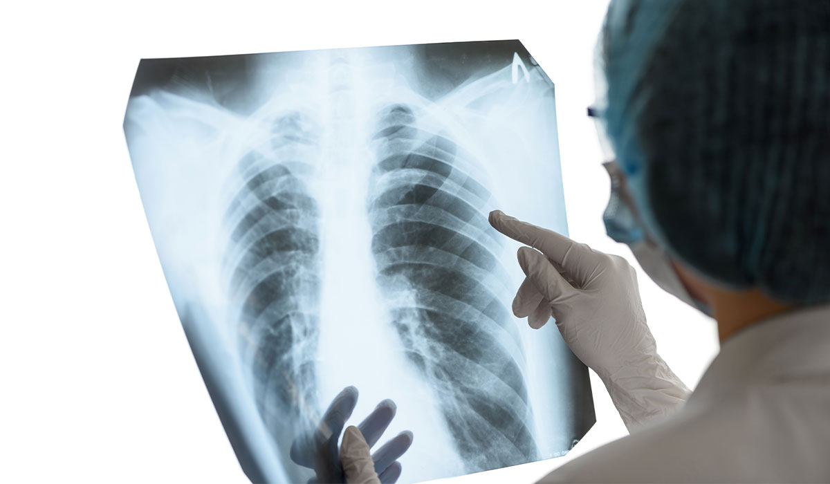 Pneumothorax: What Is, Types, Causes, and Symptoms