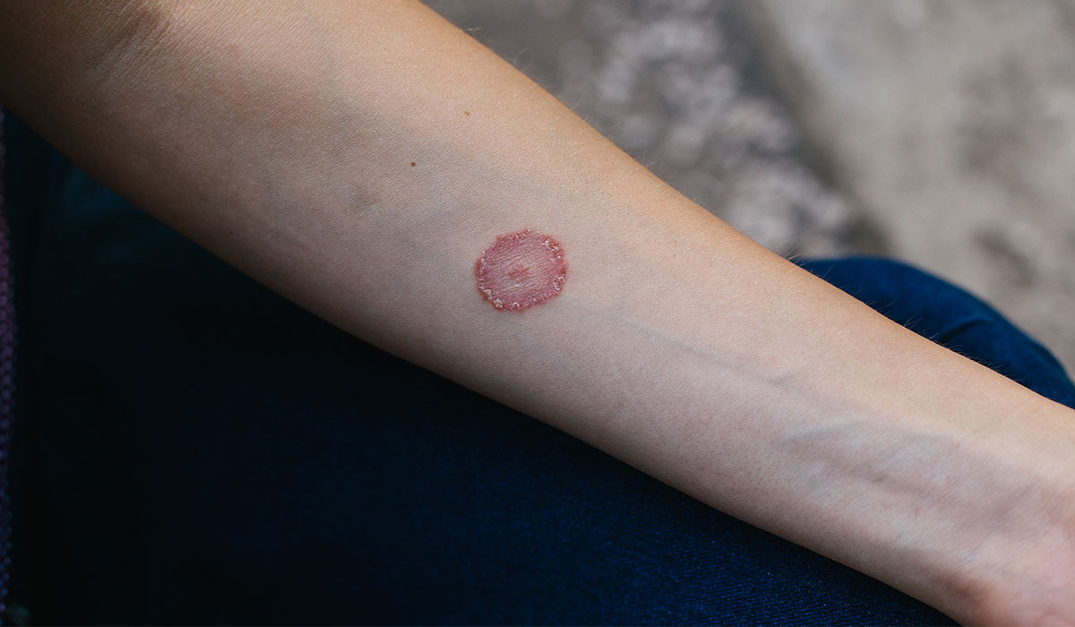 Ringworm: What Is, Causes, Types, and Treatment