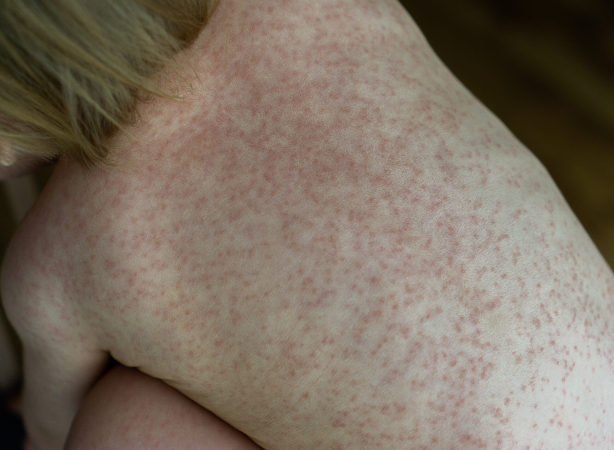 Roseola: What Is, Causes, Symptoms, Diagnosis, and Treatment