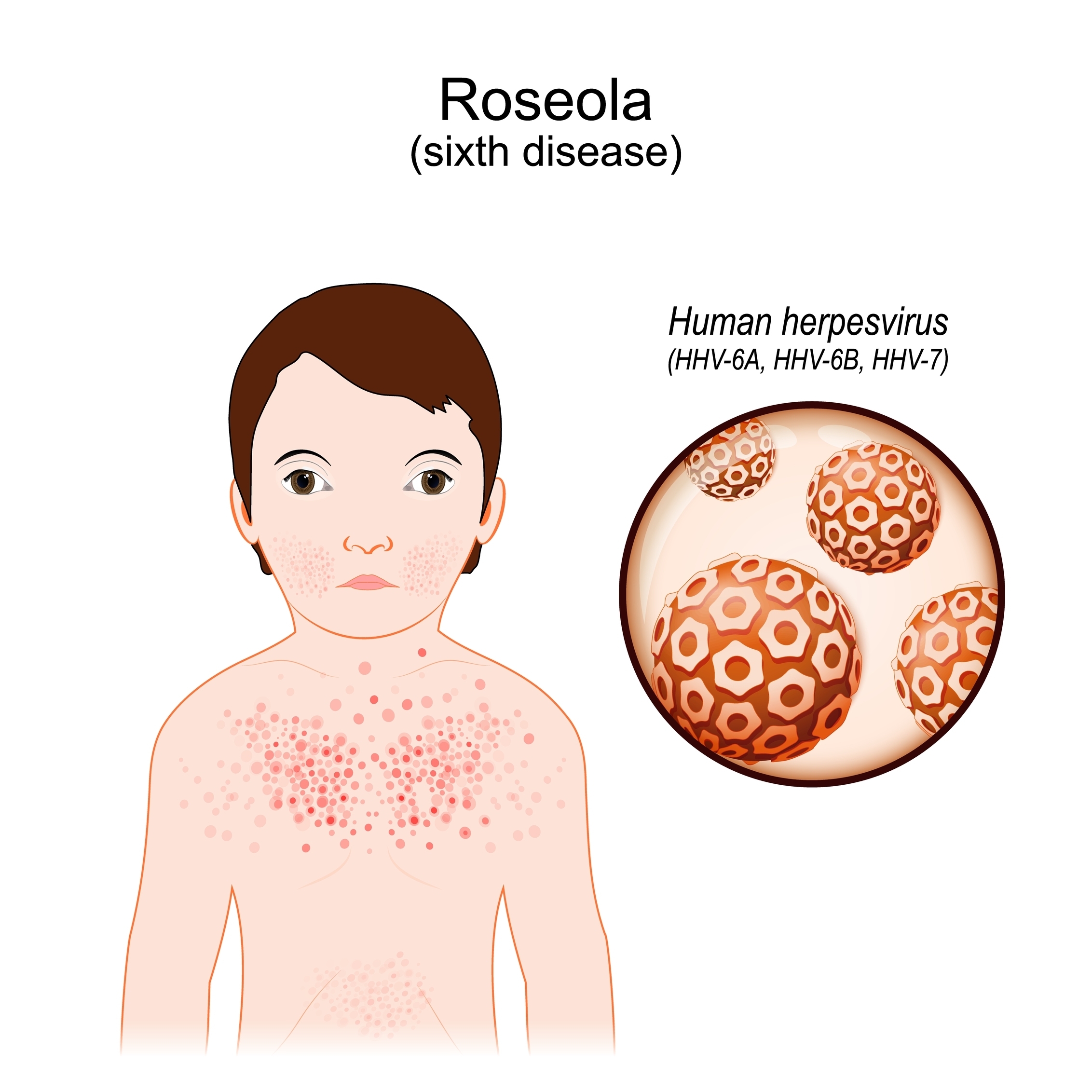 Roseola: What Is, Causes, Symptoms, Diagnosis, and Treatment