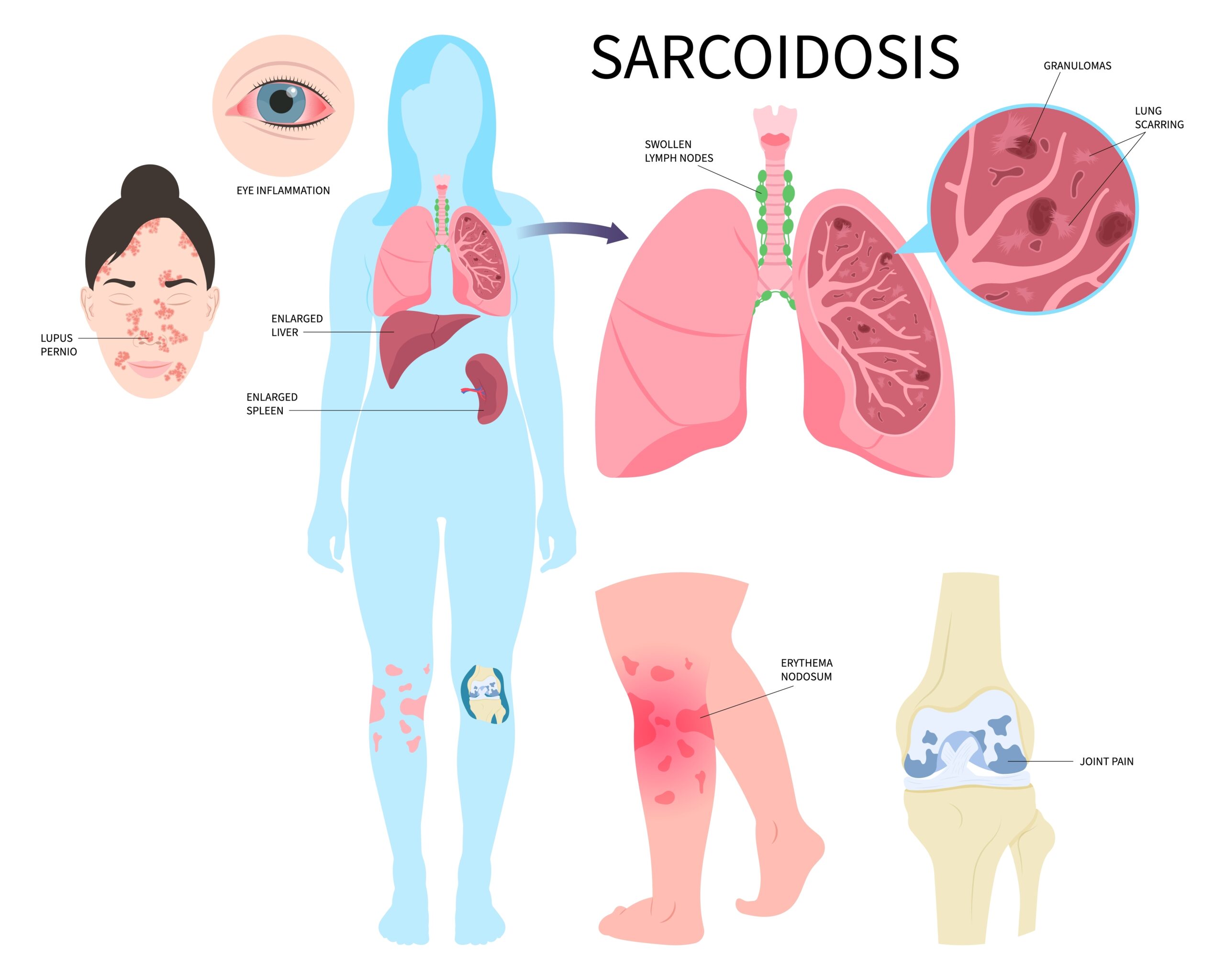 Sarcoidosis: What Is, Causes, Symptoms, and Treatment