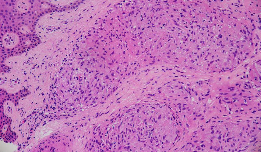 Sarcoidosis: What Is, Causes, Symptoms, and Treatment