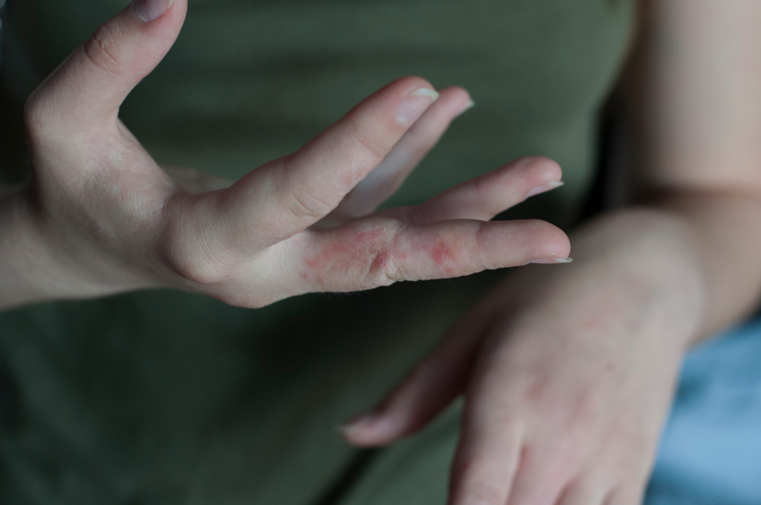 Scabies: What is, Symptoms, Treatment, Prevention, and Useful Facts
