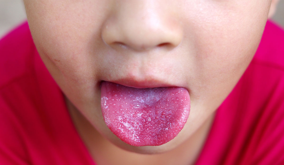 Scarlet Fever: What Is, Causes, Symptoms, and Treatment