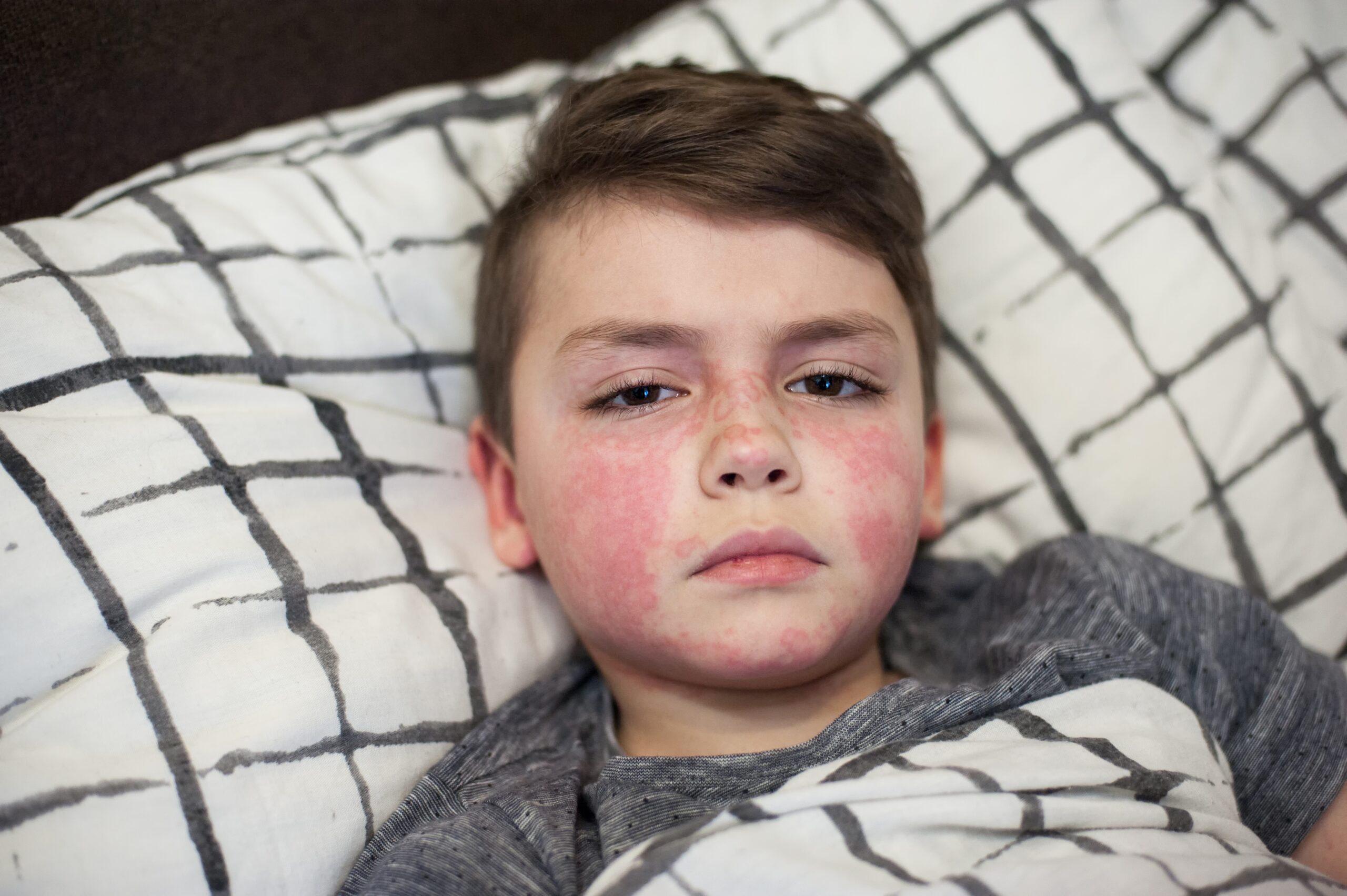 Scarlet Fever: What Is, Causes, Symptoms, and Treatment