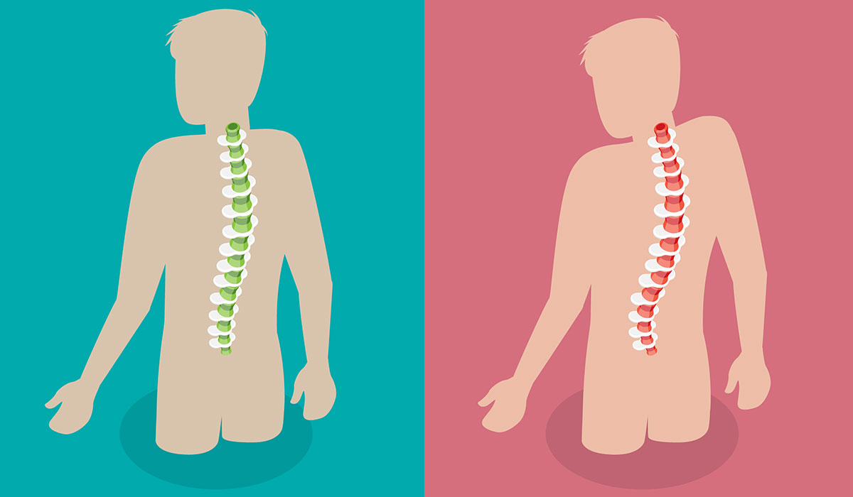 Scoliosis: What Is, Causes, First Symptoms, and Diagnosis