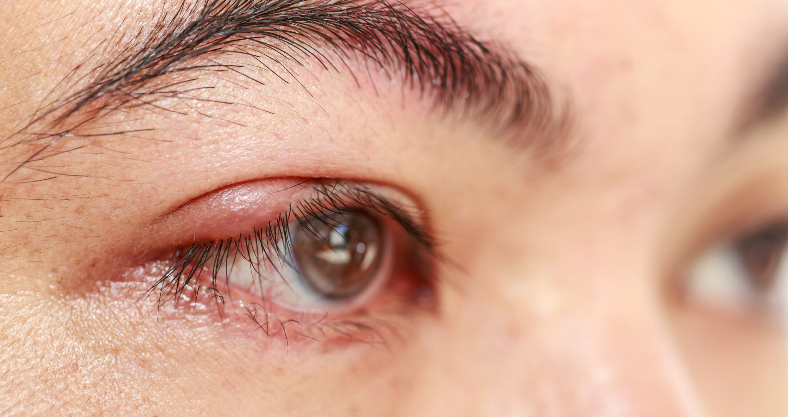 Stye: What is, Causes, Symptoms and Treatment