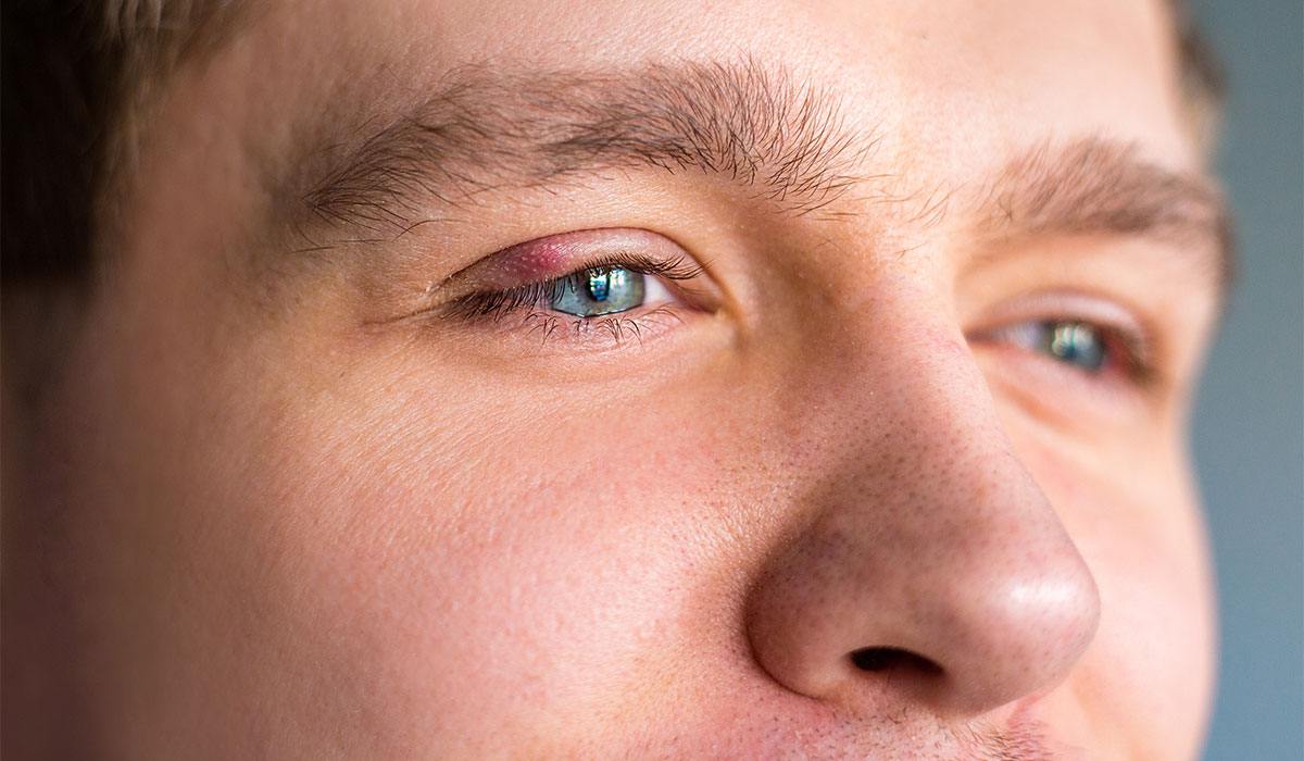 Stye: What is, Causes, Symptoms and Treatment