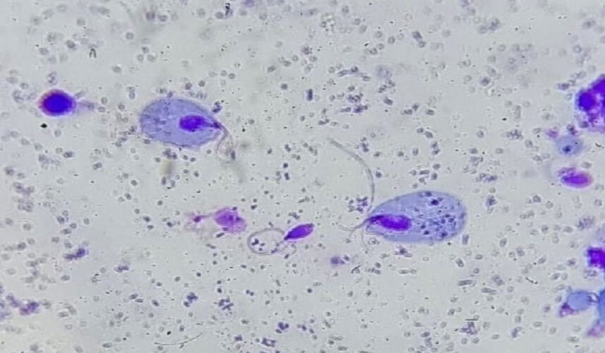 Trichomoniasis: What Is, Causes, Symptoms, and Treatment