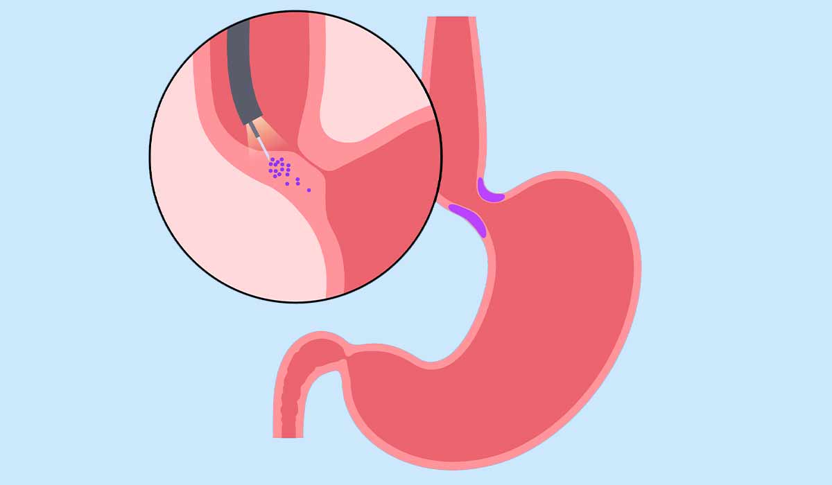 Achalasia: What Is, Causes, Complications, and Symptoms