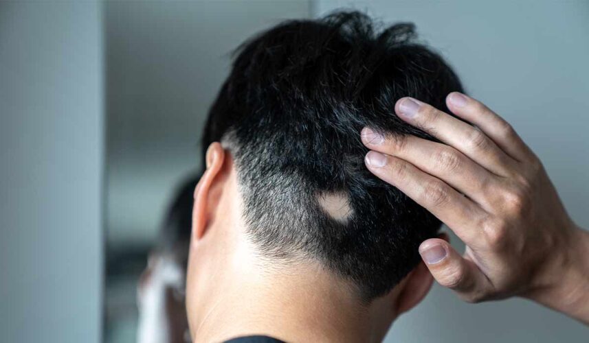 Alopecia: What Is, Types, Symptoms, Causes, Diagnosis, and Treatment